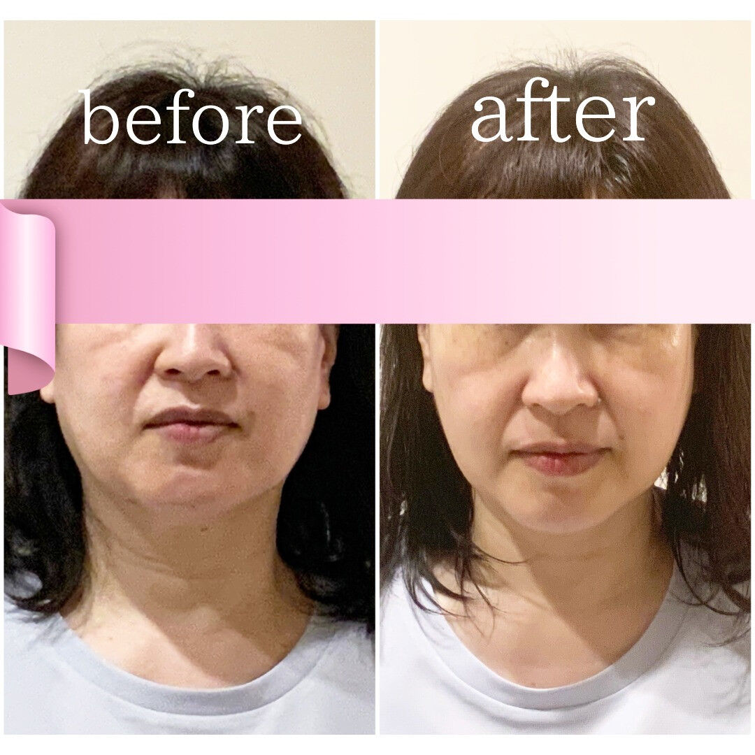 たるみ短期集中プラン【リフトアップ小顔実現コース】５０代のお